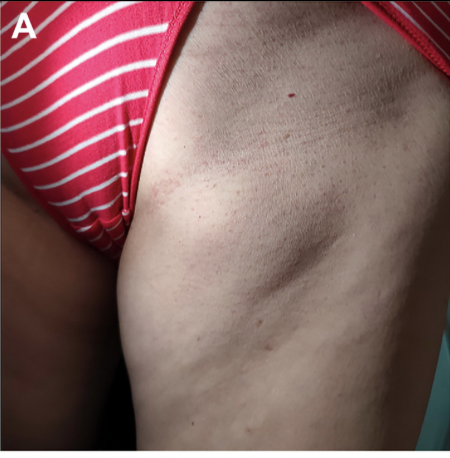 JVS - Venous and Lymphatic Disorders tweet media