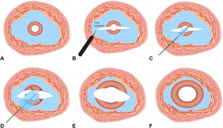Naoya Tada et al report on "Scar incision and endoscopic balloon dilation for severe benign esophageal strictures" in this Review Article. videogie.org/article/S2468-…

#GITwitter