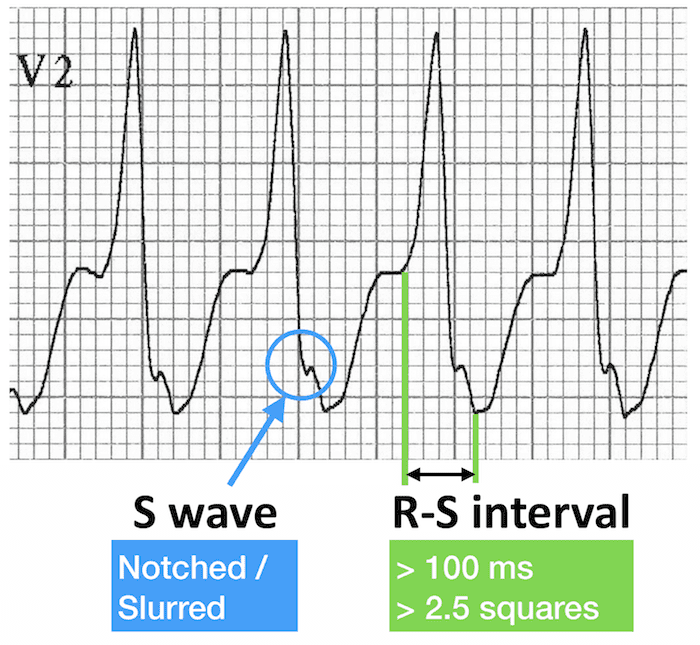 TrackYourHeart's tweet photo. 1. Can you identify the ECG signs marked in blue and green?
2. Which arrhythmia is associated with these findings? https://t.co/jzXGMpc9KM