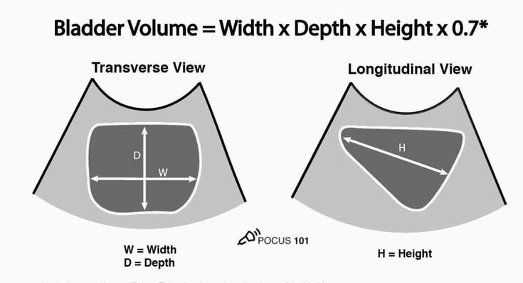 mznljrdy47597's tweet image. Bladder volume by ultrasound is estimated with the formula: Width × Depth × Height × 0.7. Measure W &amp;amp; D in the transverse view, and H in the longitudinal view.

#Ultrasound #POCUS #Radiology #Sonography #MedicalEducation #BladderScan 
#ultrasound #sonologist