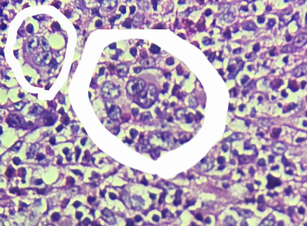 It is rewarding to see these classic Reed-Sternberg  cells in classical Hodgkin lymphoma among mixed infalmmation after meticulous search at high power. The patient is a 25 years old lady with right posterior cervical lymphadenopathy. 
#pathology #hemepath #cHL