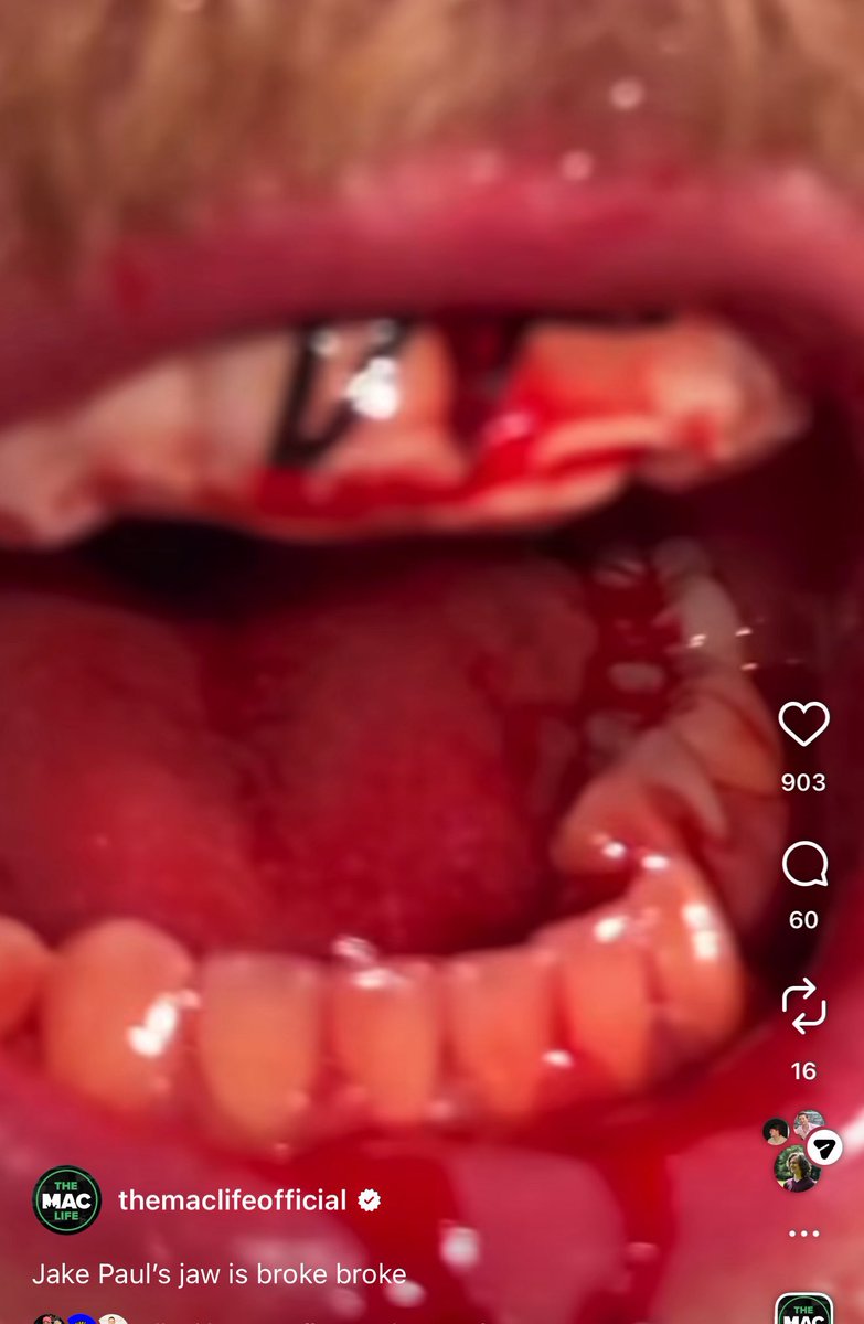 Jake got his jaw broken 😳 😂😂😂😂😂