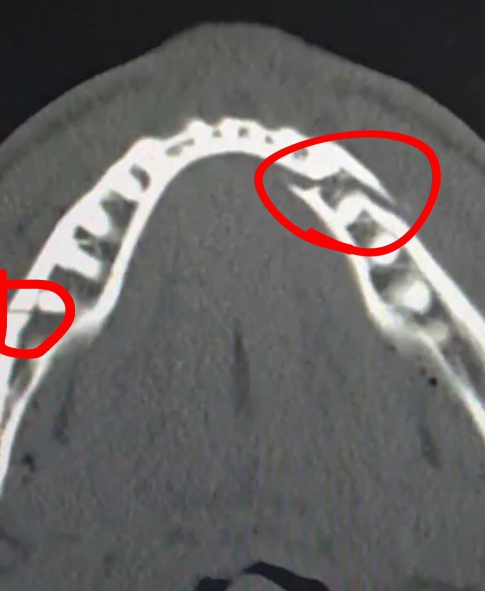 DAZNBoxing's tweet image. Jake Paul has now revealed he has a double broken jaw 😬

📸via: Jake Paul IG

#JakeJoshua