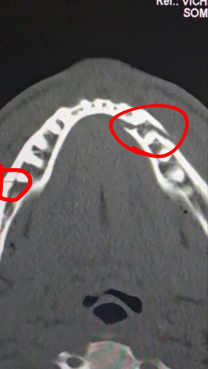 HumansNoContext's tweet image. Jake Paul confirms Anthony Joshua broke his jaw 🥶