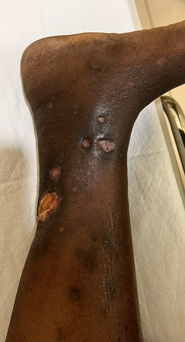 Clinical scenario — think before you scroll 👇

A woman presents with dyspnea and is diagnosed with pulmonary embolism.
Further evaluation shows thrombocytopenia.
Obstetric history reveals one living child and three second-trimester abortions.

❓ What diagnosis comes to your