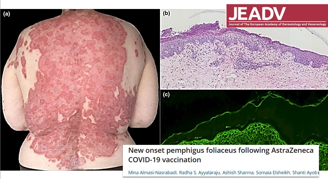 Xochipelli1953's tweet image. Apparition récente de pemphigus foliacé après AstraZeneca
 #Covidvaccination

onlinelibrary.wiley.com/doi/10.1111/jd…