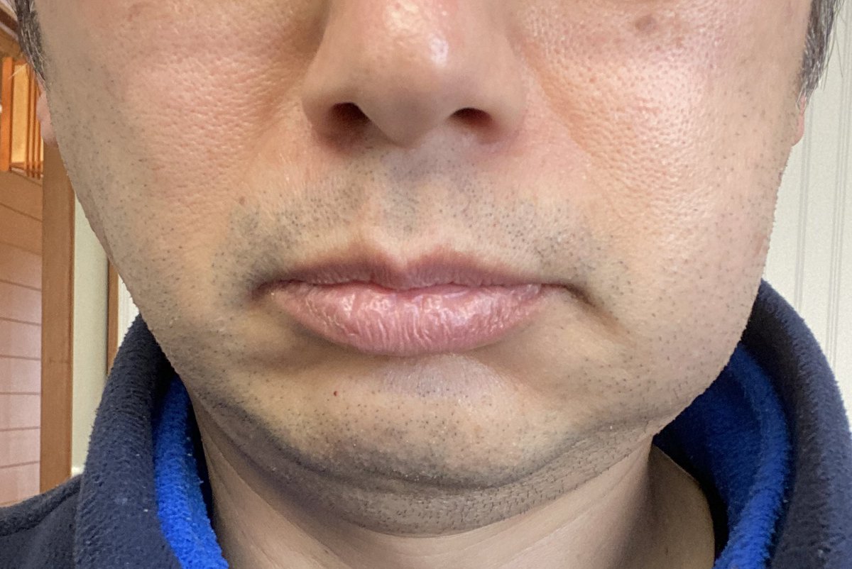 ゆうがた。親知らず抜歯後の痛み、念入りに脅された割に一晩過ぎたら痛み止め要らんくらい今んとこ平気…むしろ負荷掛けられた顎の付け根が痛くて口開け辛い感じw ただ腫れは抗生物質飲んでもどんどん悪化しててヤバい(^^;)まんま宍戸錠っつうかコブ取り爺さんですわ… 