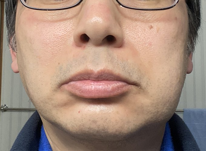 ゆうがた。親知らず抜歯後の痛み、念入りに脅された割に一晩過ぎたら痛み止め要らんくらい今んとこ平気…むしろ負荷掛けられた顎の付け根が痛くて口開け辛い感じw ただ腫れは抗生物質飲んでもどんどん悪化しててヤバい(^^;)まんま宍戸錠っつうかコブ取り爺さんですわ… 