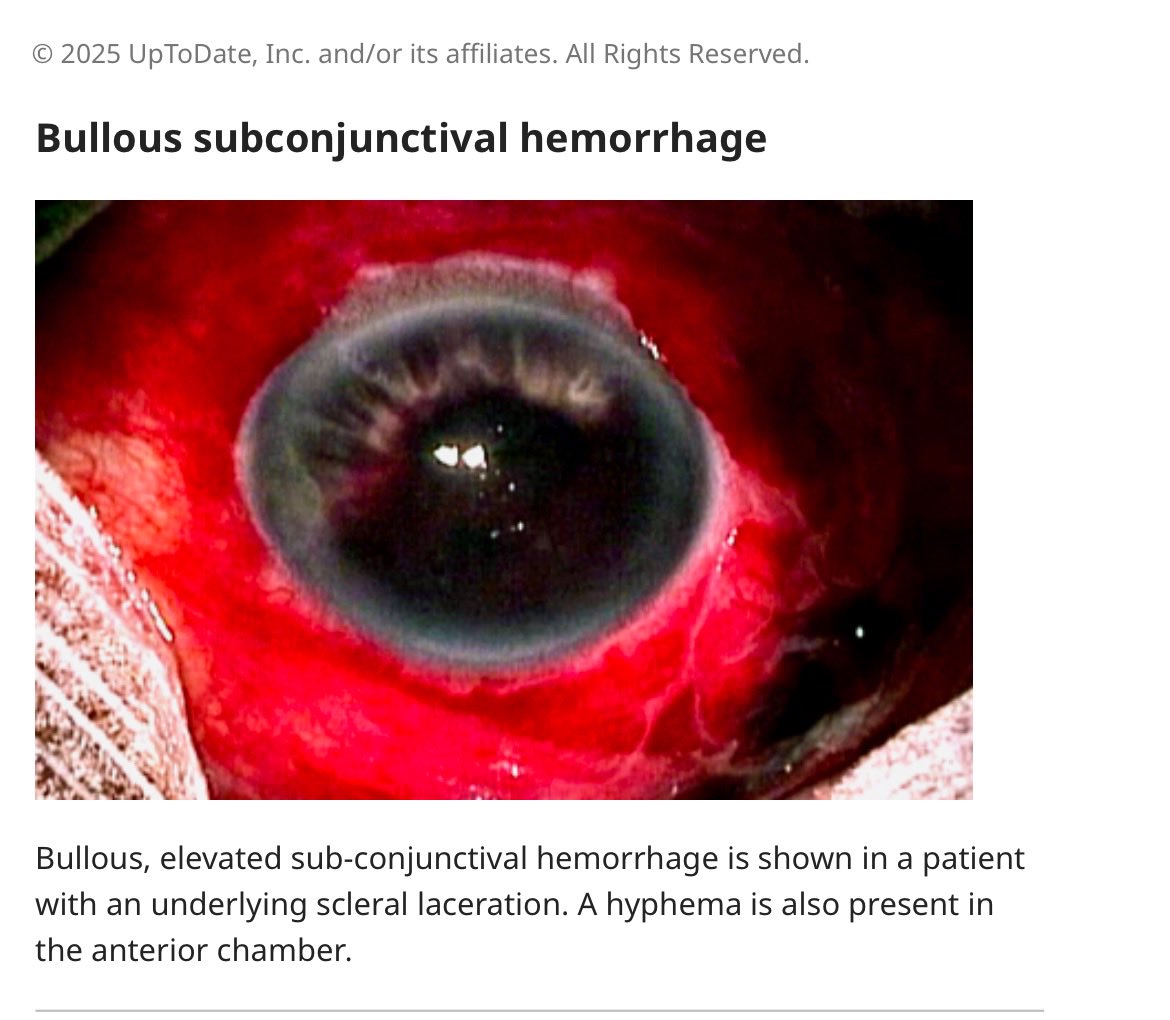 123mMohammed's tweet image. 🚨من حالات عيادة طب الأسرة 

♦️نزف تحت ملتحمة العين 
 (Subconjunctival hemorrhage)

_ يظهر على شكل بقعة حمراء واضحة على سطح العين نتيجة تجمع الدم بين الصلبة والملتحمة

_ غالبًا غير مؤلم؛ قد يشكو المريض من إحساس جسم غريب خفيف أو لا توجد أعراض إطلاقًا

_ قد يحدث تلقائيًا أو بعد رض…