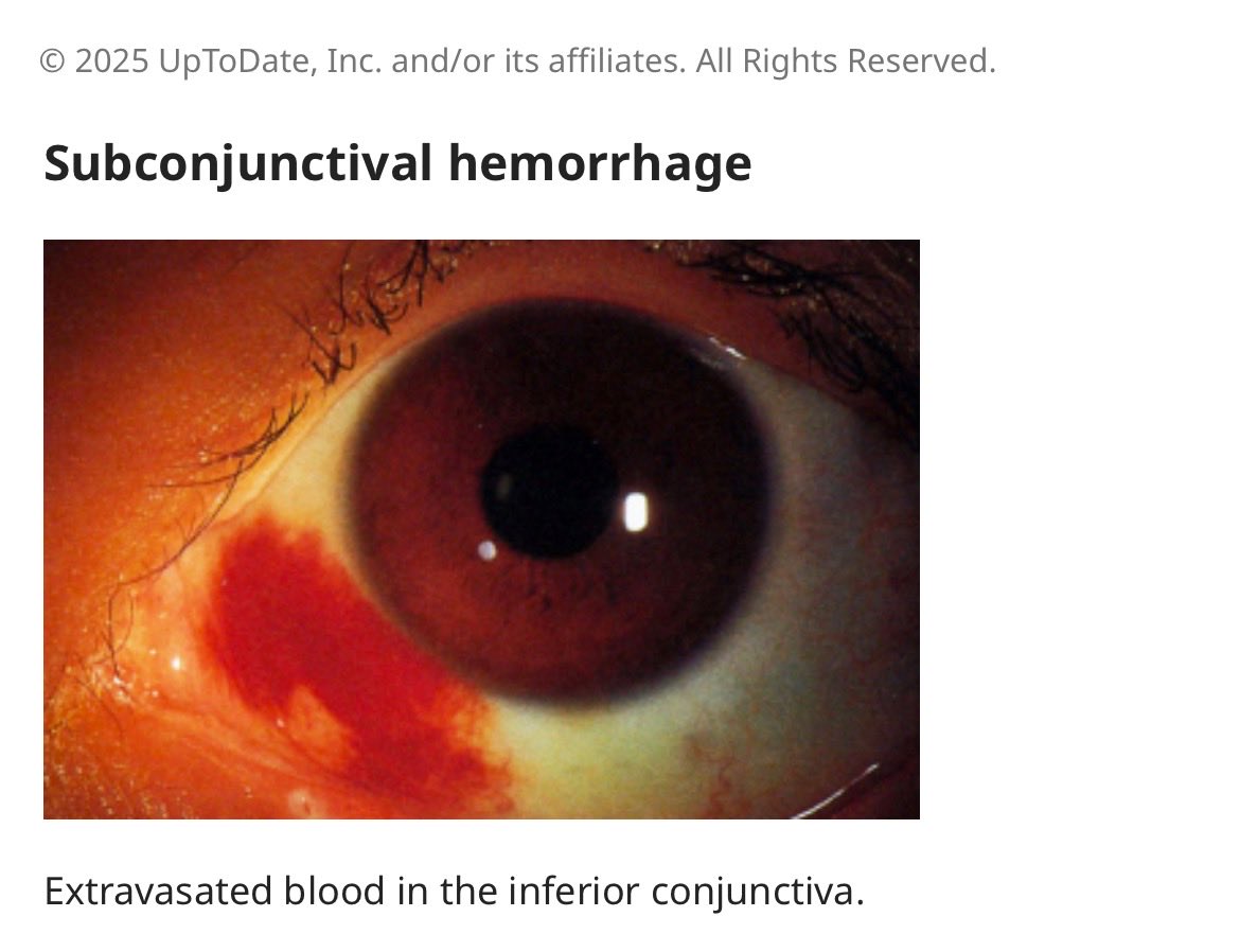 123mMohammed's tweet image. 🚨من حالات عيادة طب الأسرة 

♦️نزف تحت ملتحمة العين 
 (Subconjunctival hemorrhage)

_ يظهر على شكل بقعة حمراء واضحة على سطح العين نتيجة تجمع الدم بين الصلبة والملتحمة

_ غالبًا غير مؤلم؛ قد يشكو المريض من إحساس جسم غريب خفيف أو لا توجد أعراض إطلاقًا

_ قد يحدث تلقائيًا أو بعد رض…