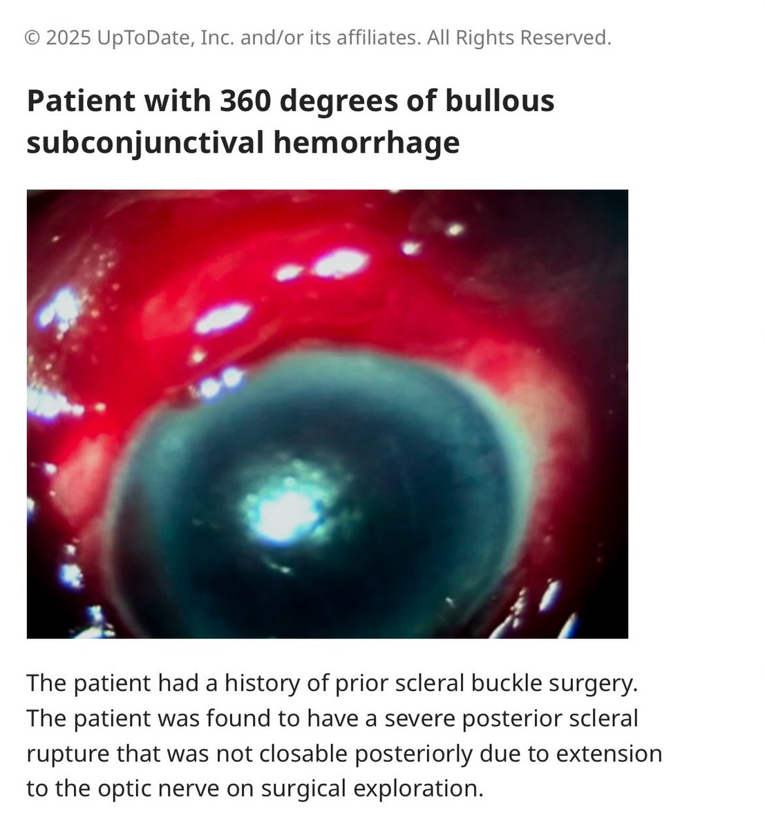 123mMohammed's tweet image. 🚨من حالات عيادة طب الأسرة 

♦️نزف تحت ملتحمة العين 
 (Subconjunctival hemorrhage)

_ يظهر على شكل بقعة حمراء واضحة على سطح العين نتيجة تجمع الدم بين الصلبة والملتحمة

_ غالبًا غير مؤلم؛ قد يشكو المريض من إحساس جسم غريب خفيف أو لا توجد أعراض إطلاقًا

_ قد يحدث تلقائيًا أو بعد رض…