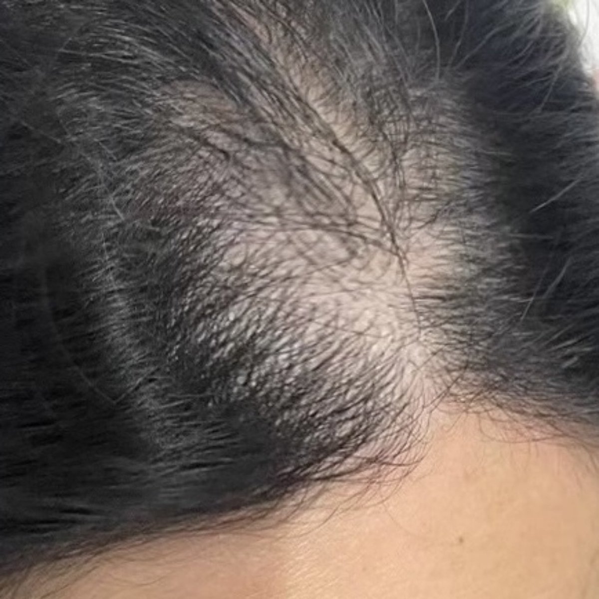 4amvanila's tweet image. ไม่พูดเยอะ คือผมที่หายไป มันขึ้นมาใหม่ แล้วยาวเร็วด้วย ใช้ไป 2 ขวด แชมพูโสมในตำนานอะ ดีมาก ผมไม่มันเร็ว ไม่แข็ง 👀🫶🏻