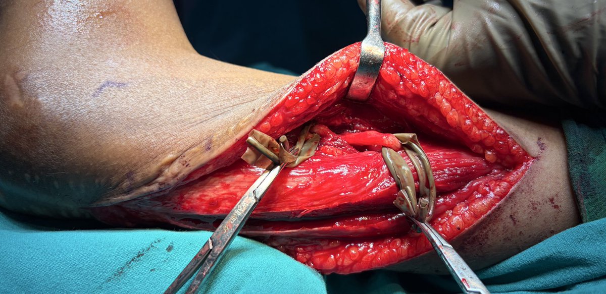 drsonipavan's tweet photo. 10 year old male, came to us 5 months postop, operated elsewhere for a SCH#, developed wrist drop and median nerve compression neuropathy. Due to MN involvement, distal tendon and nerve transfers are out of the question. See what we did instead. Will update the follow up. https://t.co/cXs4JhfayD
