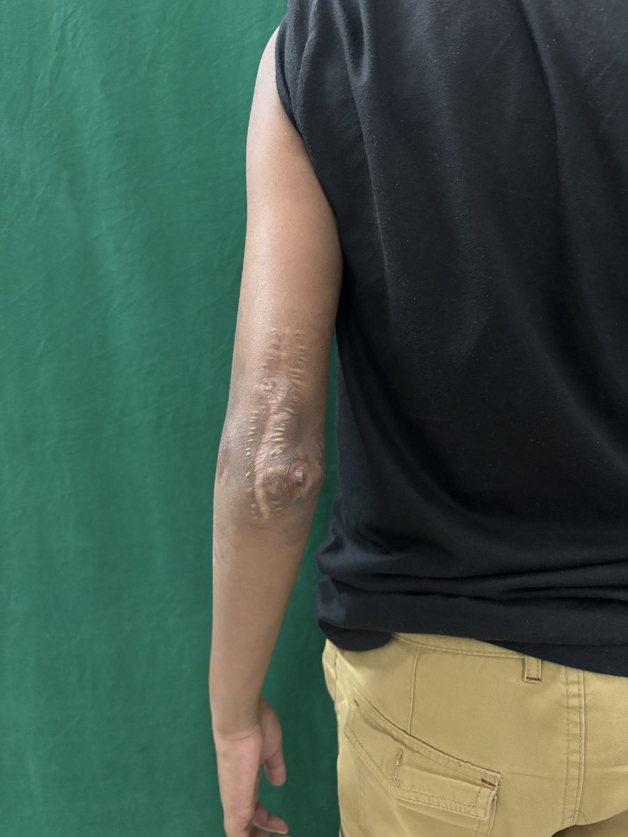 drsonipavan's tweet photo. 10 year old male, came to us 5 months postop, operated elsewhere for a SCH#, developed wrist drop and median nerve compression neuropathy. Due to MN involvement, distal tendon and nerve transfers are out of the question. See what we did instead. Will update the follow up. https://t.co/cXs4JhfayD