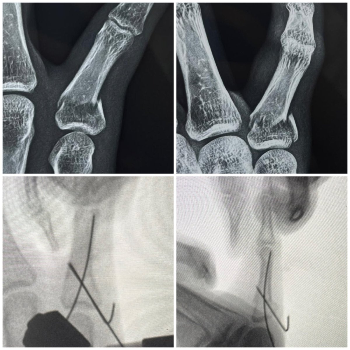 drsonipavan's tweet photo. 23y/male, 5 days old injury
Done in wrist block.

How many of you would have done ORIF plating for this ? https://t.co/WSFmLNPCQb