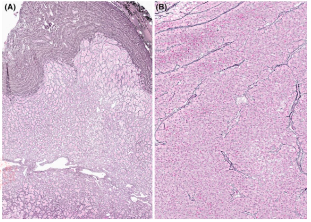 Updates on the pathology of adrenal tumors from <a href="/RDWhaleyMD/">Rumeal D. Whaley, MD</a> 

onlinelibrary.wiley.com/doi/epdf/10.11…