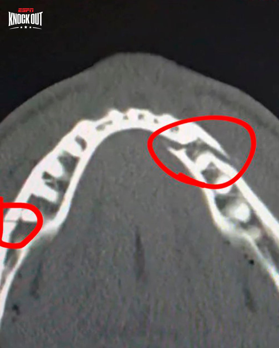 ESPNKnockOut's tweet image. 😱 ¡DOBLE FRACTURA DE MANDÍBULA PARA JAKE PAUL TRAS SU PELEA CON ANTHONY JOSHUA!

🥊 En sus redes sociales, el estadounidense confirmó su lesión después de perder por K.O. técnico en Miami ante el ex campeón mundial de los pesos pesados.

🤔 ¿Qué te parece?