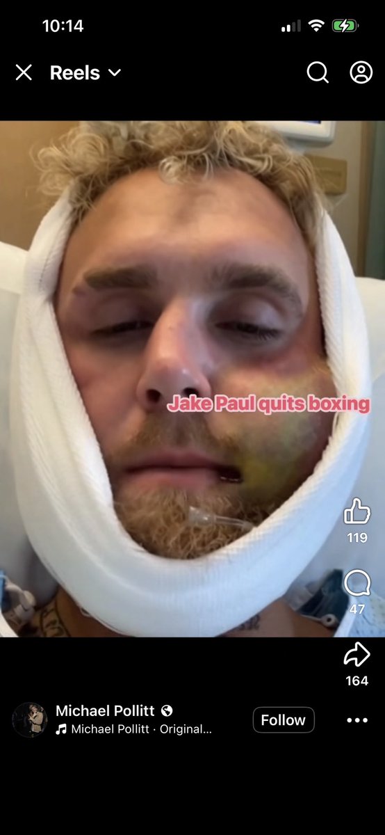 NSC2200's tweet image. Sweet jaw @jakepaul #boxing #mma #CombatSports #brokenjaw #JakeJoshua