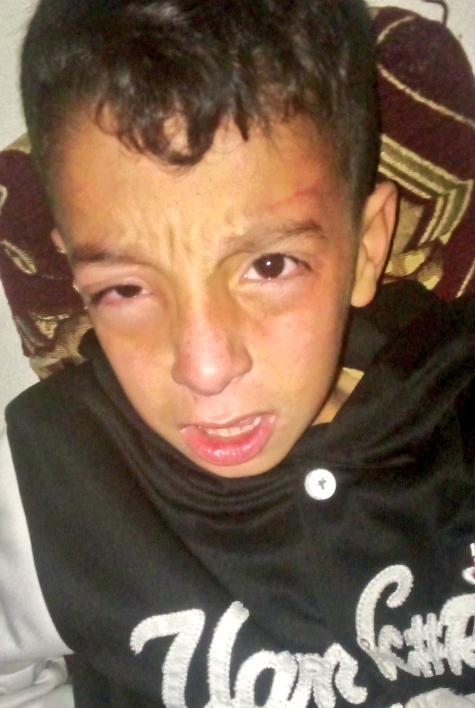 RozeatG's tweet image. My son has an eye infection, and it's getting worse every day. His eye is red and painful, and he can't open it normally The doctor said he needs urgent treatment before his vision is affected further. I'm appealing to anyone who can help my orphaned child
chuffed.org/project/137260…