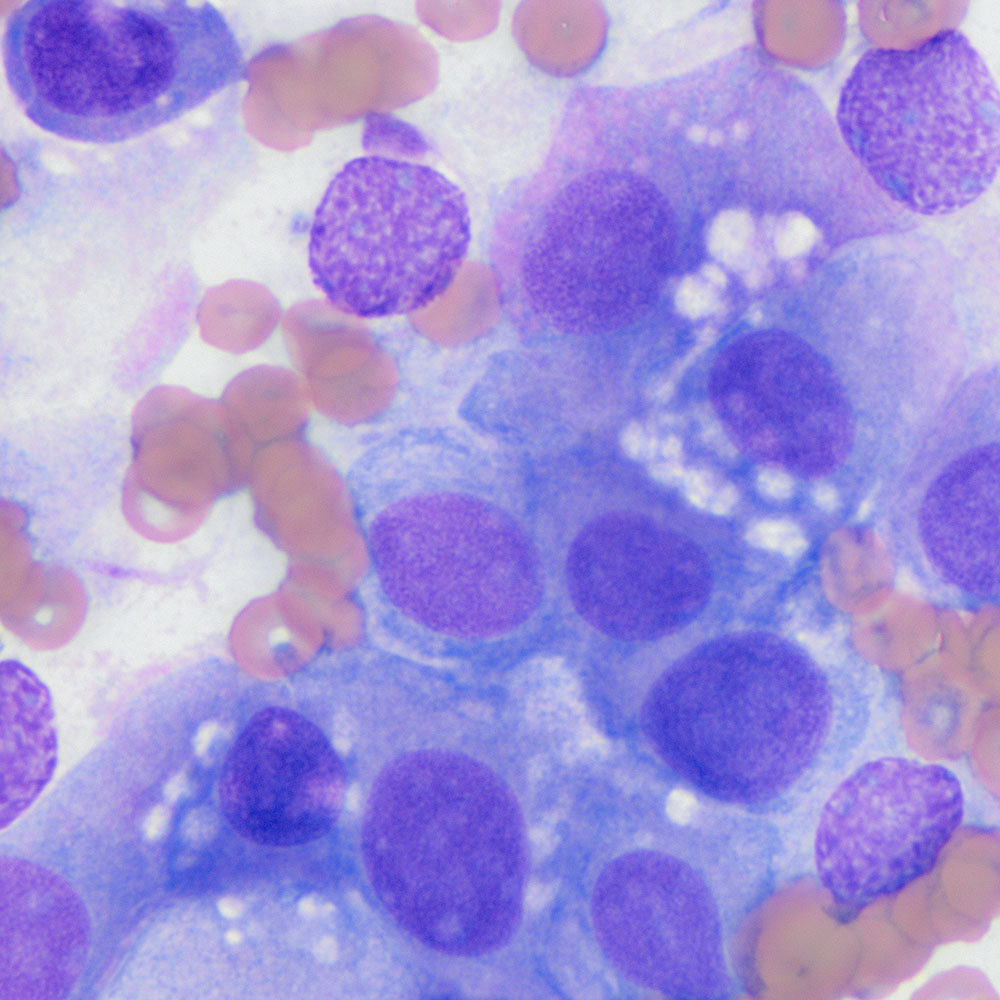 eClinPathCU's tweet photo. Our latest diagnostic challenge: An aspirate from the spleen of a dog with a mast cell tumor. Check it out  https://t.co/RzNkgHC5zN https://t.co/z2qTY978t8
