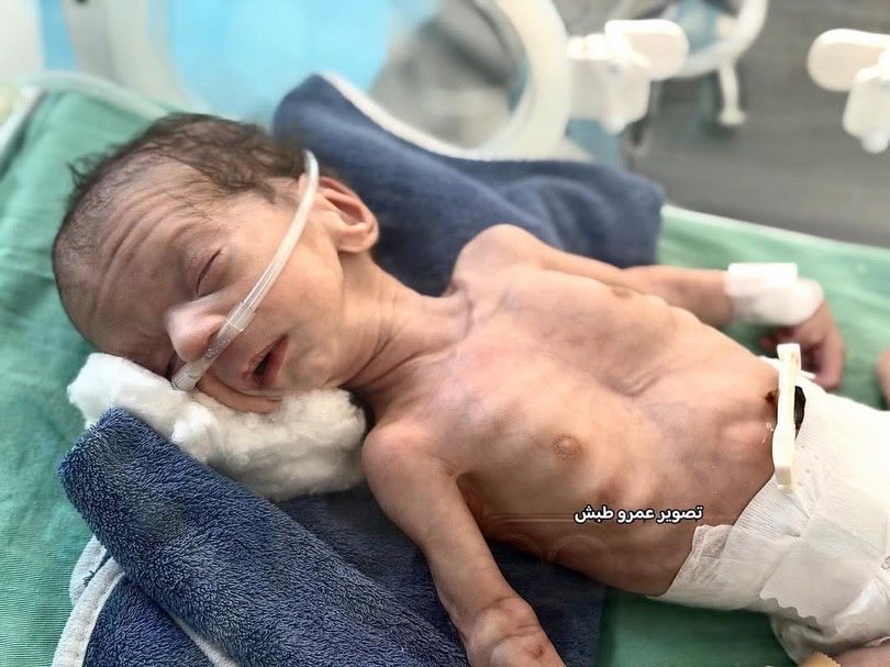 After losing her newborn... mother Hanan is now fighting for her life.
The intant Hassan Wadhan (17 days old) passed away after suffering from a severe heart condition that required urgent surgical intervention, in addition to non-fatal congenital deformities.