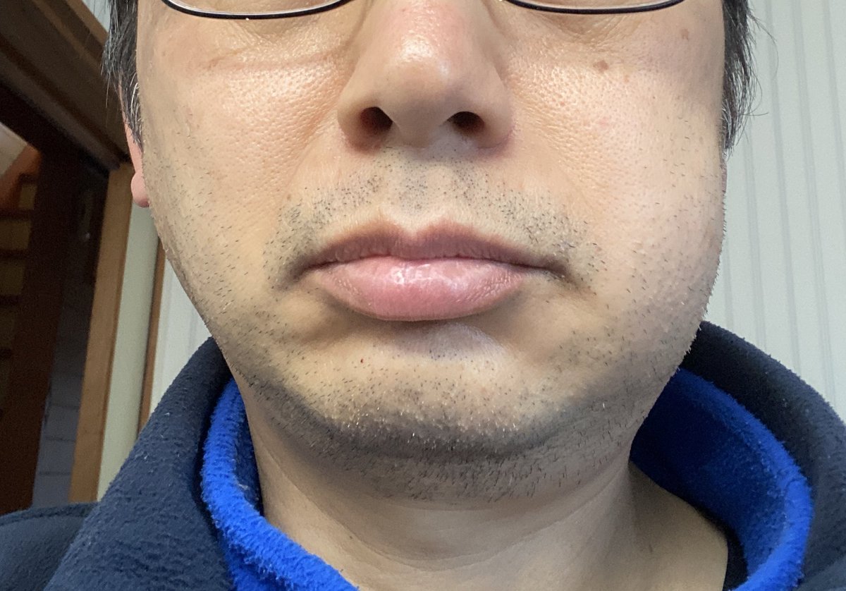 ひるすぎ。やべーなあ左頬の腫れが更に進行して首の方まで膨らんできてる…この状態でほとんど傷まない(歯肉切開したとこは一応痛い)のが逆にブキミなんすが(ー ー;) 風呂も入っちゃダメだろうし、このツラじゃ明日も休んだ方がいいかな… 