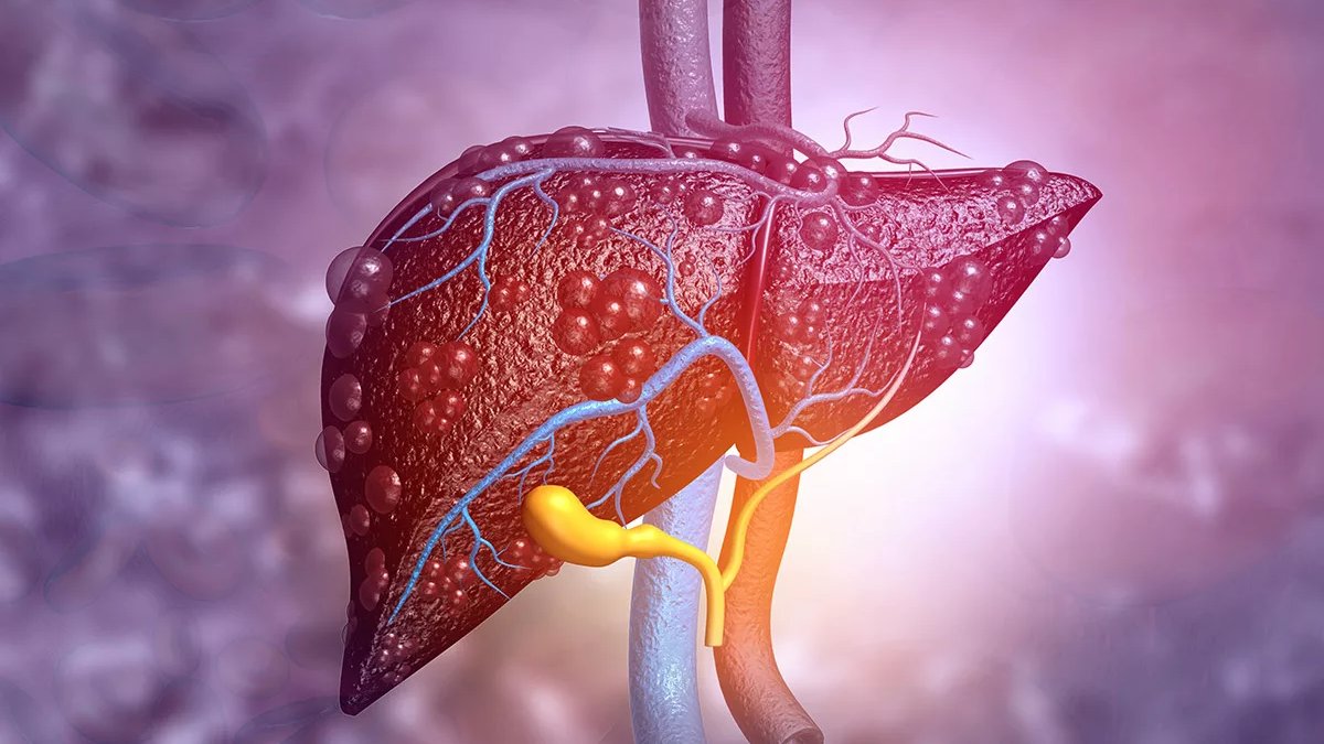 لمرضى الكبد الدهني: 7 أطعمة ممنوع أن تأكلها نيئة.. احذرها 