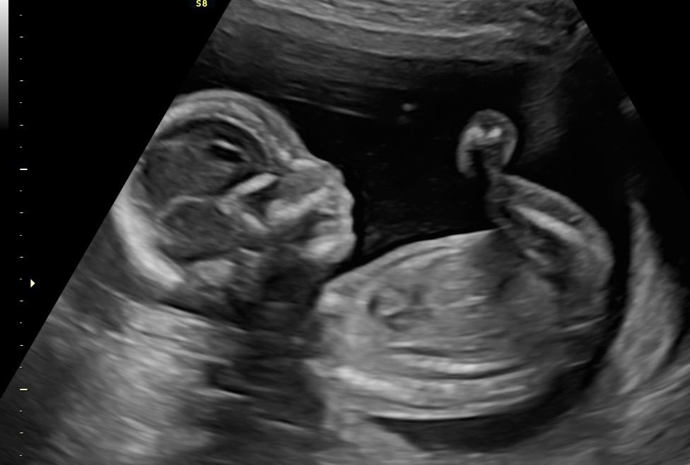 caitywaity6's tweet image. I might be making a supermodel, look at those legs!