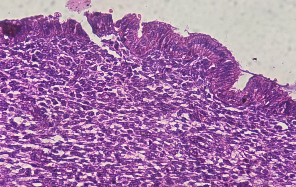 An incidental finding of cervical endometriosis chacterized by presence of endometrial glands and stroma within cervix. She had twisted right ovarian emdometriotic cyst.
#pathology #gynepath