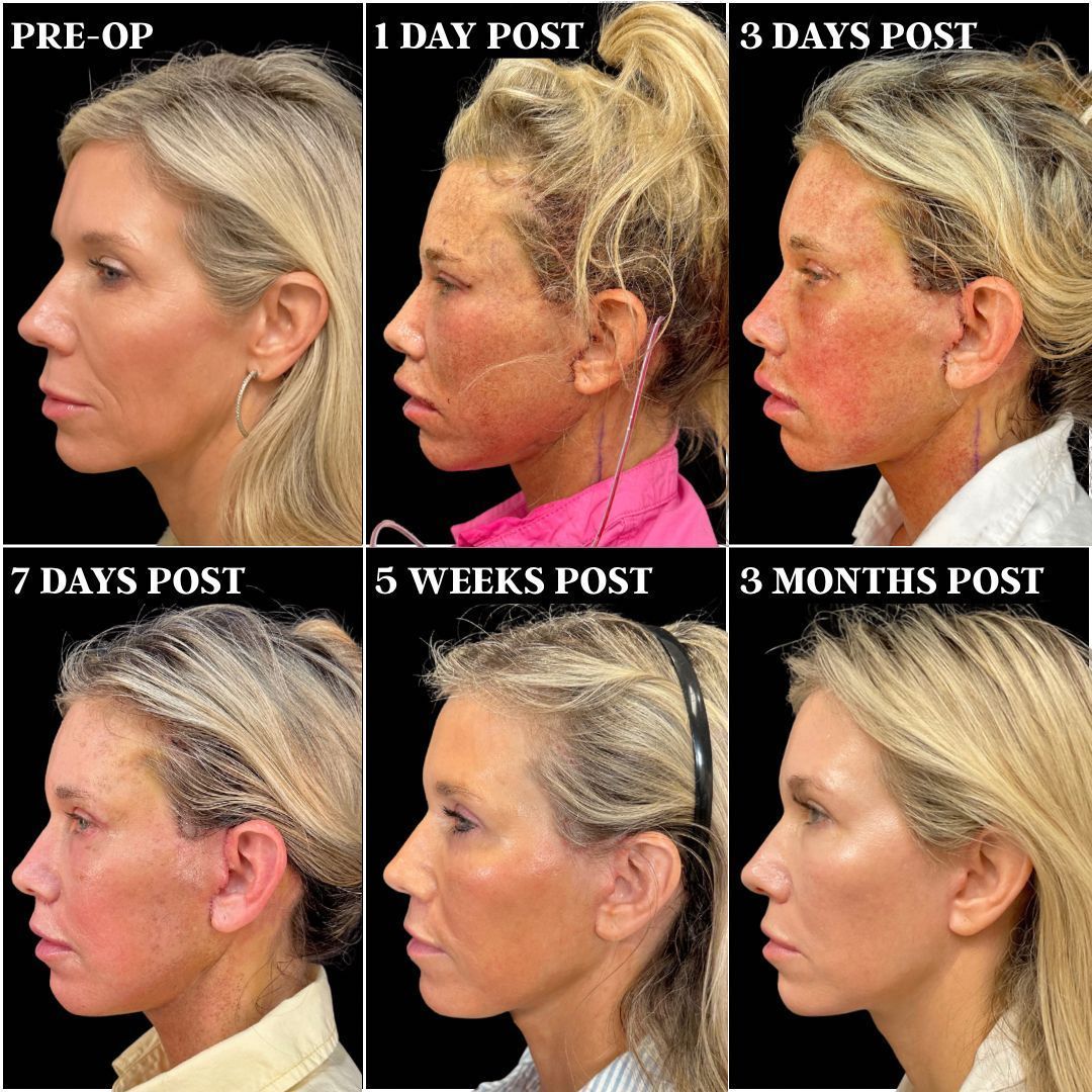 RobbJrMD's tweet image. 6 moments. 1 Robb Refresh. 👀

This image shows the journey, not just the reveal — from early healing to refined, natural results after a deep plane facelift + deep neck lift with a few sneaky tweaks along the way 🤌🏼