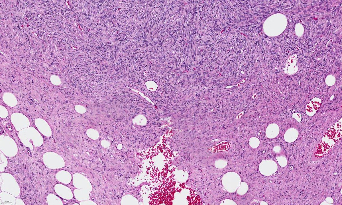 drtimbracey's tweet photo. 20-year “sebaceous cyst” on the trunk. A bland spindle cell tumour with storiform architecture, diffuse strong CD34 positivity, and characteristic honeycomb infiltration of subcutis. Indolent but locally aggressive, with high recurrence risk if incompletely excised.DFSP #skinpath https://t.co/5sM7gwX4jI