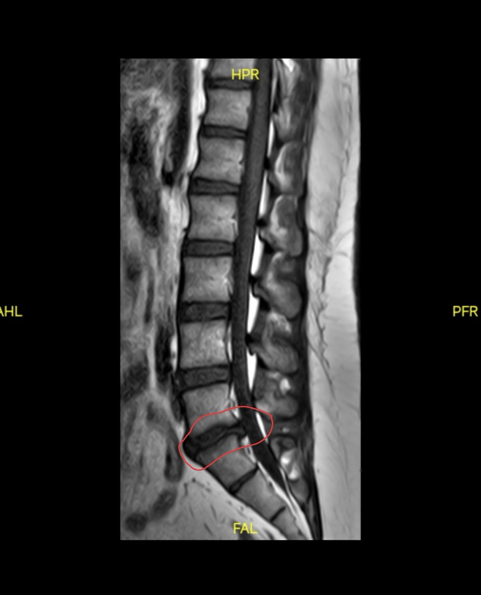 Due to a serious lumbar disc injury, I’ve decided to pause all current projects for the next two months to undergo surgery and focus fully on recovery. Taking this time off is necessary to heal properly and come back in better shape.

Thank you for your understanding and support.