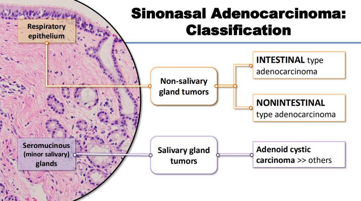 Janiranavarro's tweet photo. Sinonasal Adenocarcinoma Classification

Non-salivary gland tumors
- Intestinal type adenocarcinoma
- Nonintestinal type adenocarcinoma
Salivary gland tumors

Dr. Nishino - 2025 Diagnostic Pathologic Update #USCAP #pathology #PathX