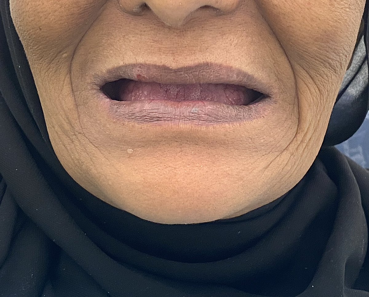 LujainDent's tweet photo. There’s something so rewarding about giving a patient their smile back🦷✨ https://t.co/xYy9aMM9We