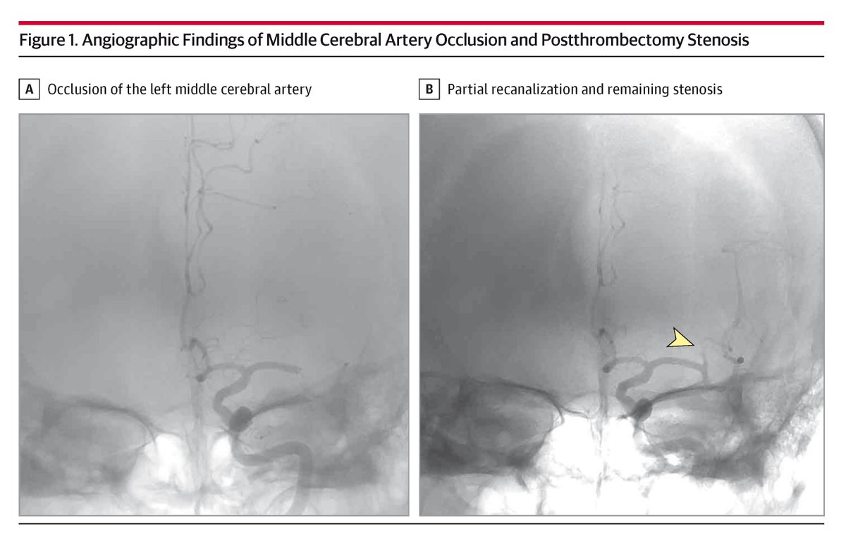 JAMANeuro's tweet photo. Case report: A 73-year-old woman presented with dysarthria and right-sided hemiparesis (NIH-Stroke Scale score of 9). https://t.co/QYCWE2Q74E https://t.co/l5TMPIK0Cs
