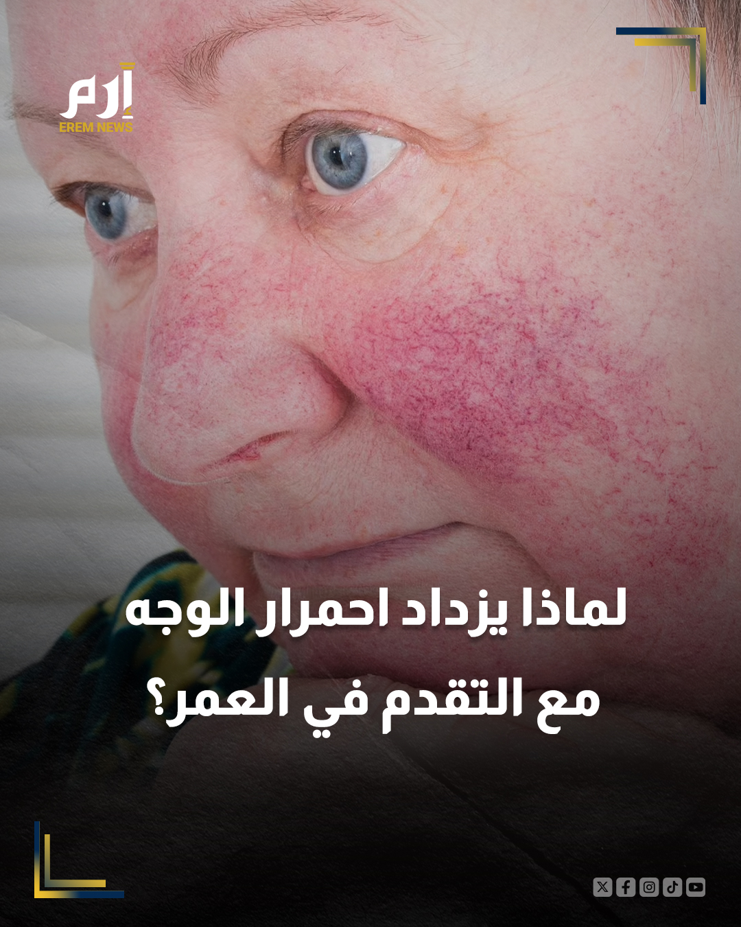 وفقا لصحيفة "نيويورك تايمز"، لا يعرف العلماء السبب الدقيق لتفاقم الوردية مع العمر، إلا أن هناك بعض النظريات. وتقول الدكتورة جولي سي. هاربر، طبيبة الجلدية في ألاباما، إن سنوات التعرض للمحفزات البيئية يمكن أن تؤدي إلى التهاب مزمن يضعف الأنسجة المحيطة بالأوعية الدموية، ما يجعلها تتسع بمرور الوقت ويزيد الاحمرار المستمر ويفاقم الهبات الساخنة. وتشير الدكتورة دينا الراشيدي إلى أن الشيخوخة الطبيعية للبشرة وفقدان مرونتها، بالإضافة إلى أضرار الشمس، تجعل الأوعية الدموية أكثر وضوحًا، مع زيادة أعراض الجفاف والشعور بالشد والحرقان.. لتفاصيل أكثر | 