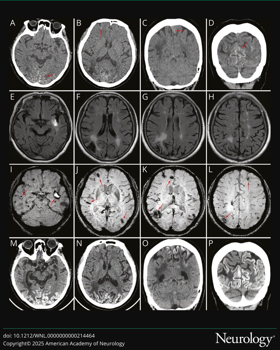 GreenJournal's tweet photo. Ribbon-Like Cortical Calcifications in Hereditary Cerebral Hemorrhage With Amyloidosis-Dutch Type: https://t.co/kDwV7mdS6i https://t.co/0MYpn2Qm6c