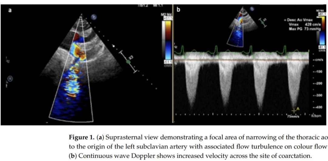 javier20ch's tweet image. Indicaciones de intervención en Coartacion Aórtica. 🫀🧐🔎
🟢[IC]: está indicada la reparación de la coartación o recoartación aórtica en pacientes hipertensos con aumento del gradiente de la presión no invasiva entre las extremidades superiores e inferiores confirmada por una…
