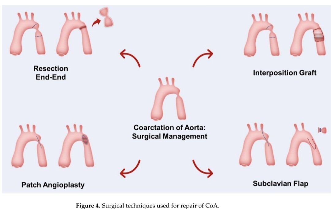 javier20ch's tweet image. Indicaciones de intervención en Coartacion Aórtica. 🫀🧐🔎
🟢[IC]: está indicada la reparación de la coartación o recoartación aórtica en pacientes hipertensos con aumento del gradiente de la presión no invasiva entre las extremidades superiores e inferiores confirmada por una…