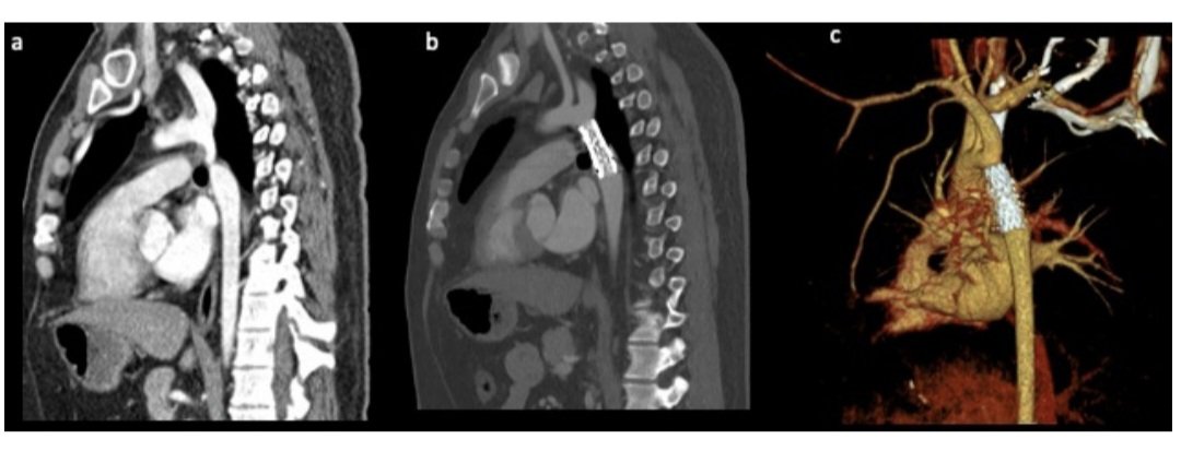 javier20ch's tweet image. Indicaciones de intervención en Coartacion Aórtica. 🫀🧐🔎
🟢[IC]: está indicada la reparación de la coartación o recoartación aórtica en pacientes hipertensos con aumento del gradiente de la presión no invasiva entre las extremidades superiores e inferiores confirmada por una…