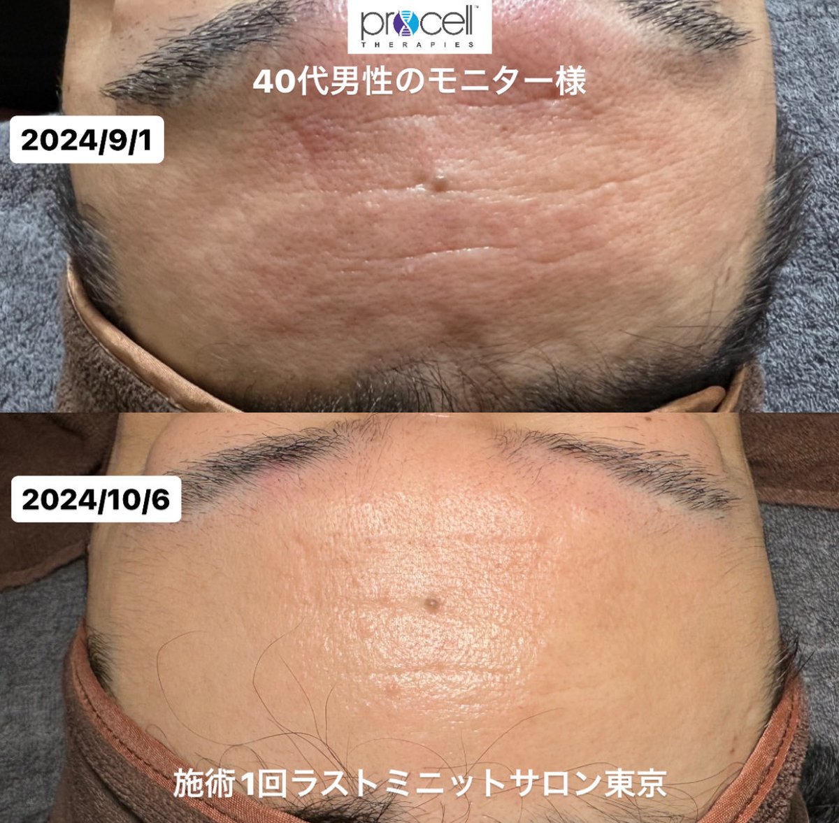 WT2833's tweet photo. 先日、プロセルセラピーズの表彰式があり、全国500加盟店の中から
全国6位／東京2位に選んでいただきました🏆

感謝の気持ちで胸がいっぱいです🙏

薄毛・シワ・目の下のクマ・肝斑・シミなど、
医療でも改善を感じられなかった方へ。

まずはカウンセリングだけでも大歓迎✨
お気軽にご相談ください✨ https://t.co/nD6z6RXvym