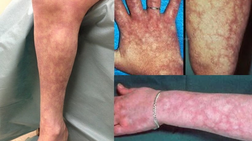 أعاني من إجهاض متكرر، وظهرت على بشرتي خطوط داكنة ما السبب؟ 