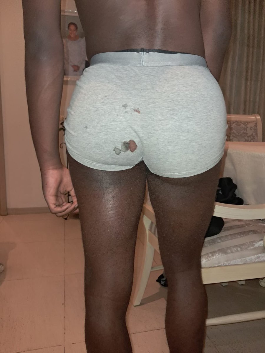makoba_y's tweet photo. #RDC: 🚨‼️🛑Claudien LIKULIA LIFOMA (18 ans) Christopher LIKULIA MUSHOBEKWA (17 ans) fils de Mme @MushobekwaMa ont été séquestrés (durant 7 heures) , torturés, molestés, chicotés par la garde de Philémon Mambabwa Zero, responsable au sein de l’#ANR dans sa résidence sous ses ordres. Ils sont admis dans un hopital de #Kinshasa.