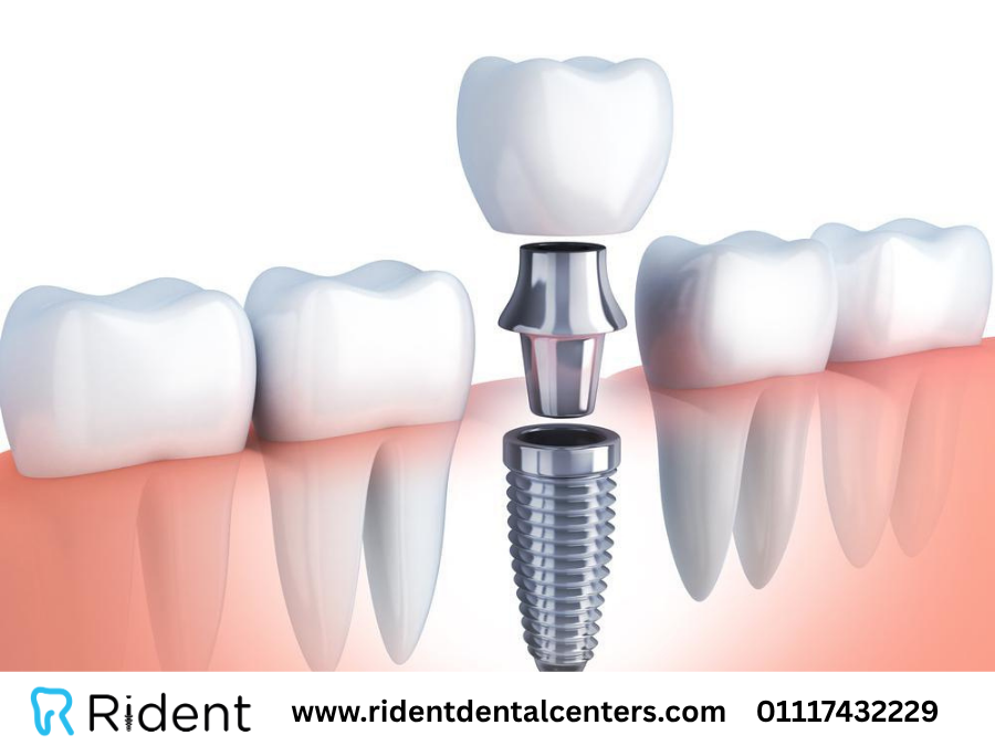 زراعة الأسنان الفوري خلال 48 ساعة 
اعرف المميزات والفرق بين الزراعة الفورية والتقليدية، واستعيد ابتسامتك بمظهر طبيعي ووظيفة ممتازة 
 المقال كاملًا:
ridentdental.onlineزرع-الأسنان-الفوري/