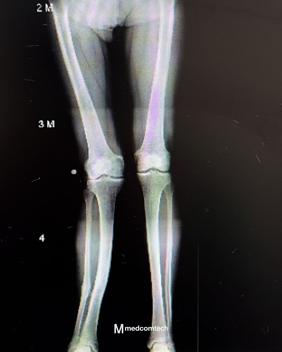 medcomtech_sa's tweet photo. Paciente de 62 años con gonalgia, dolor en tobillo ipsilateral y deformidad en valgo de la tibia derecha tras una consolidación viciosa antigua.

Se realizó una osteotomía de cierre con guía personalizada @ValorImplant https://t.co/P6CVibYZGf