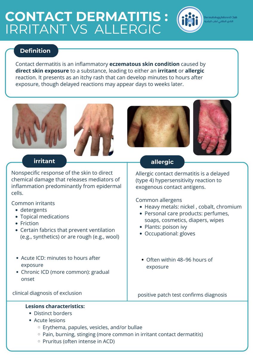 OfficialSICinit's tweet image. Contact dermatitis is one of the most common inflammatory eczematous skin disorders, and it’s far more common than atopic dermatitis, yet less discussed! 

Learn about contact dermatitis and its different types in this visual poster!✨