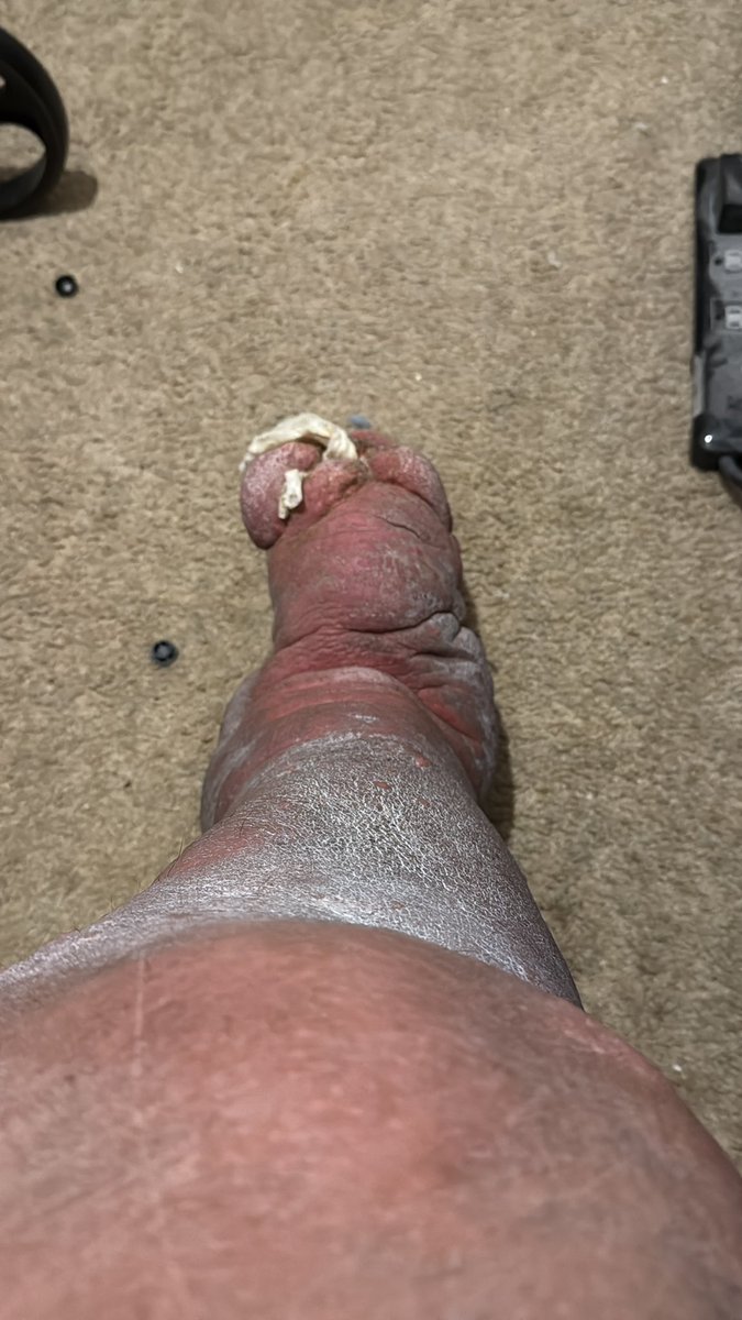 CipherDec's tweet photo. Early morn’n cellulitis flare up. #cellulitis #lymphedema https://t.co/wYImWDbjRS