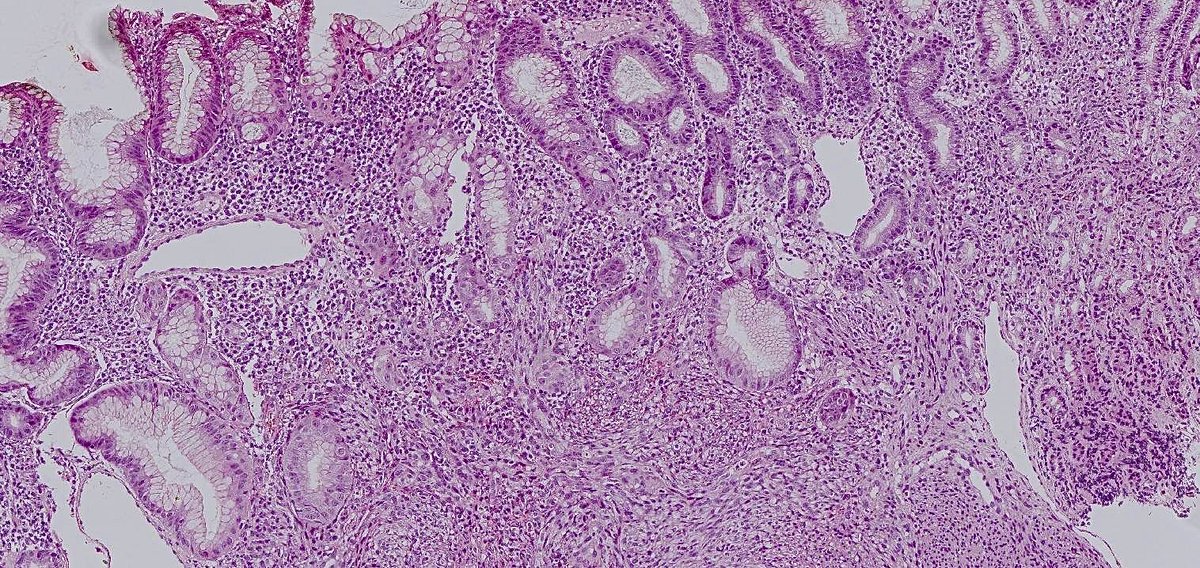 RunjanChetty's tweet photo. The mantra is a gastric spindle cell neoplasm is a GIST. What is the H&amp;E diagnosis? We are losing the art of observational pathology so don’t ask for IHC or molecular diagnostics; just commit. @kriyer68 https://t.co/HrODg54Cue