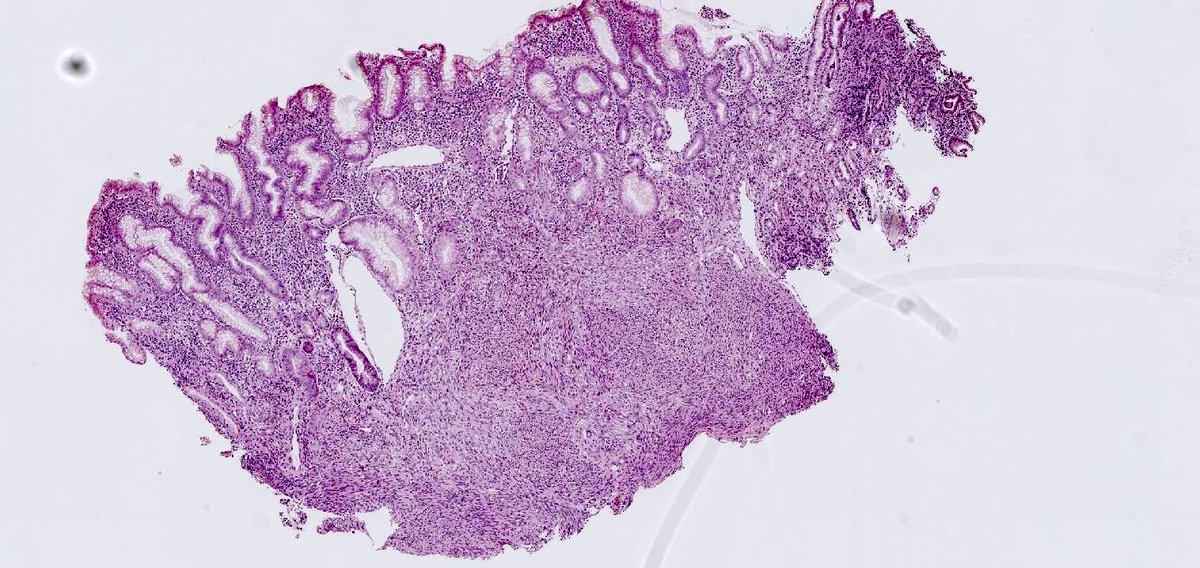 RunjanChetty's tweet photo. The mantra is a gastric spindle cell neoplasm is a GIST. What is the H&amp;E diagnosis? We are losing the art of observational pathology so don’t ask for IHC or molecular diagnostics; just commit. @kriyer68 https://t.co/HrODg54Cue