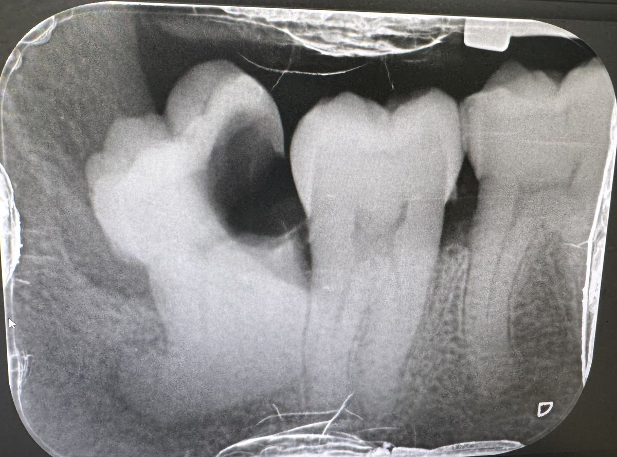 เหมือนฟันคุดกำลังอ้าปาก🦷 จะกินหัวเพื่อน 🤨